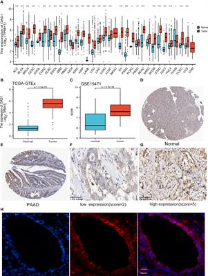 Overexpression of OAS1 Is Correlated With Poor Prognosis in Pancreatic Cancer